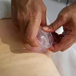 Cupping Therapy